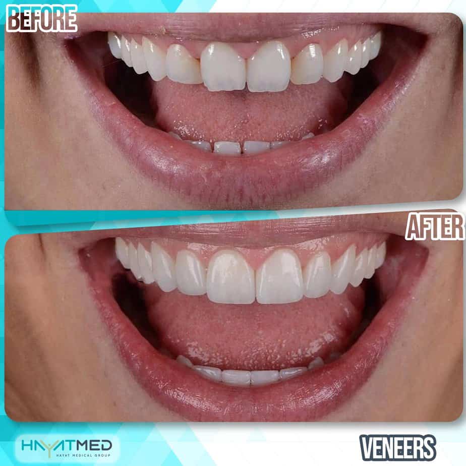 Cost Of Veneers In Turkey Best Quality Real Guarantee